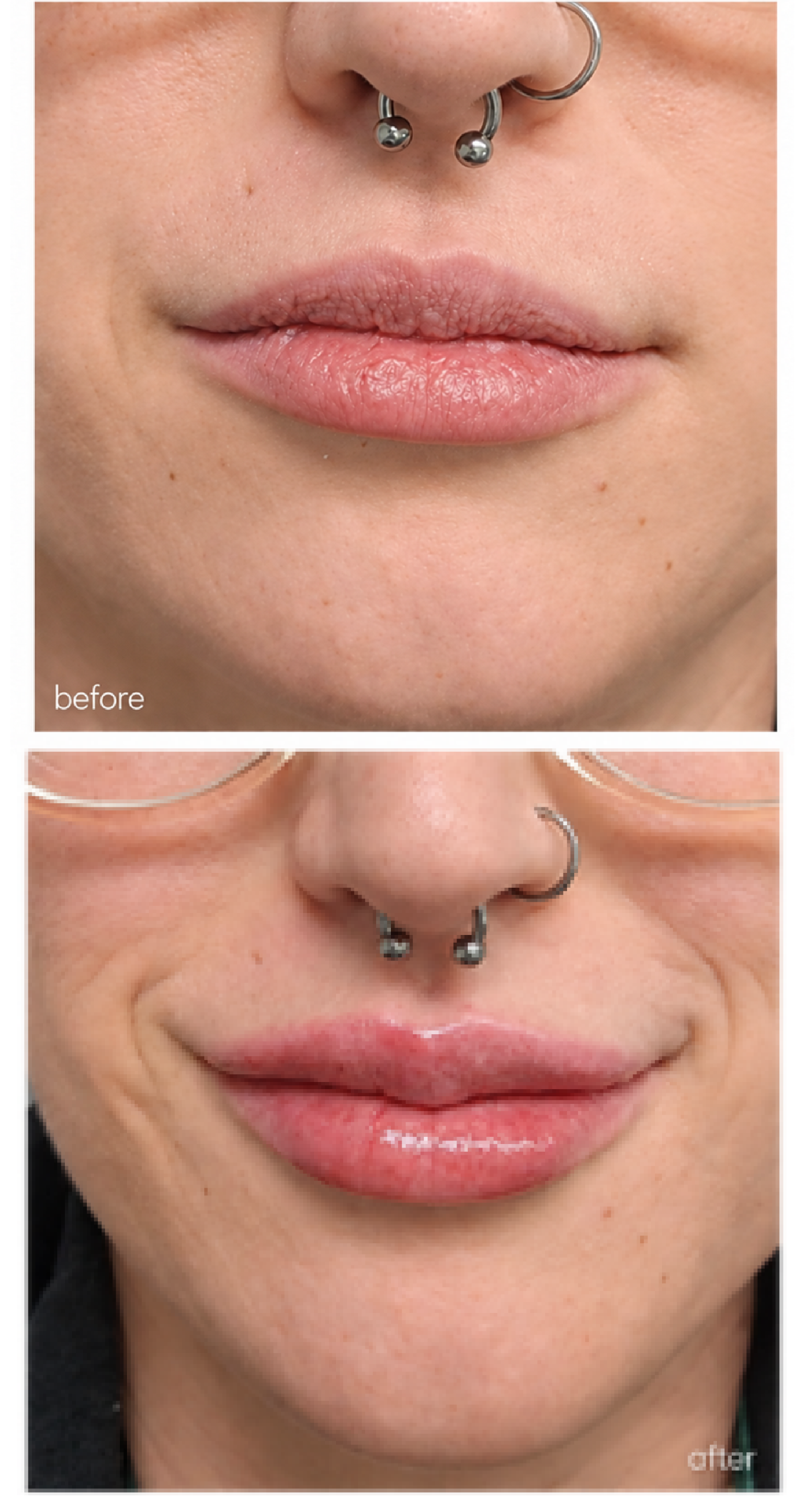LIP FILLERS page4 exact 1 scaled