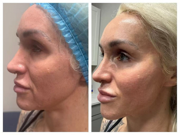 pdo threadlift before after 01