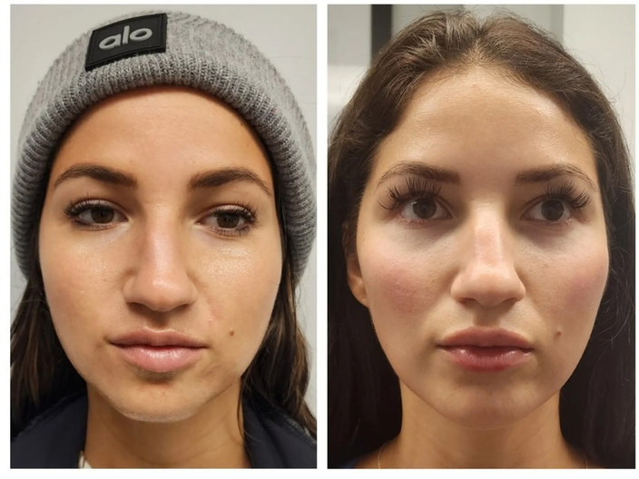 pdo threadlift before after 02