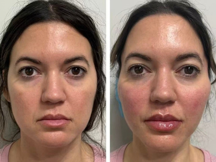 pdo threadlift before after 03