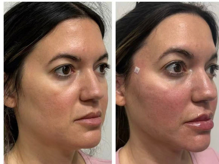pdo threadlift before after 04