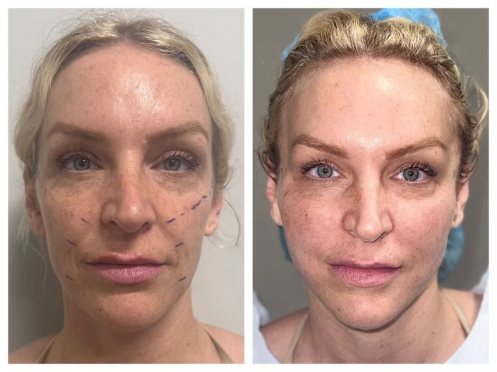 pdo threadlift before after 05