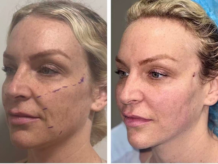 pdo threadlift before after 06
