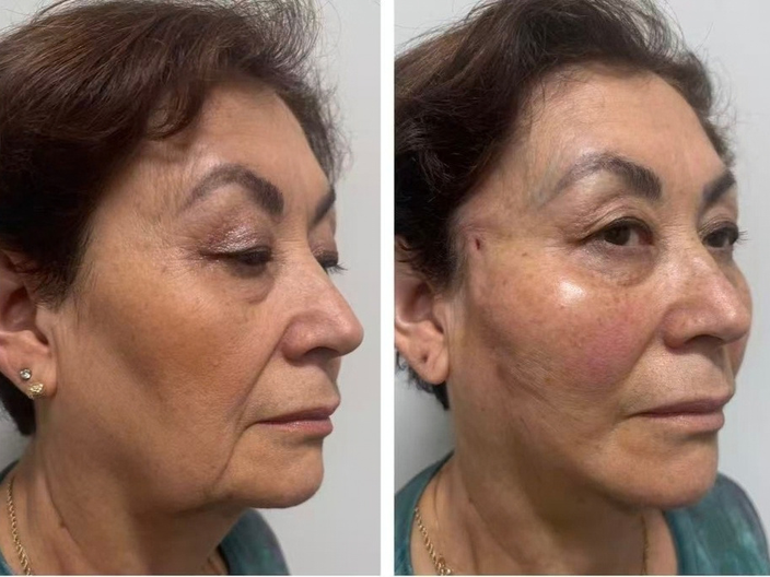 pdo threadlift before after 07