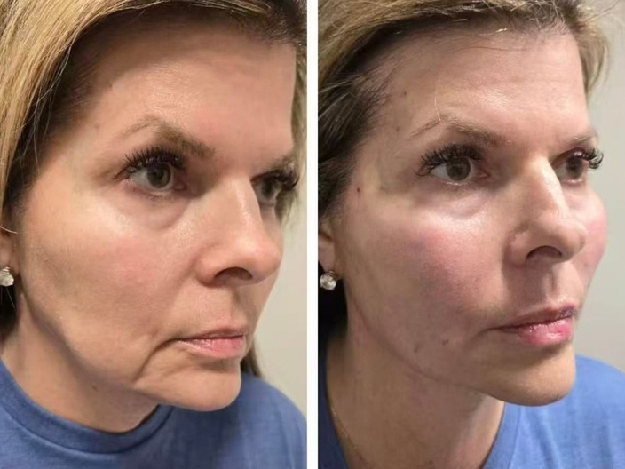 pdo threadlift before after 08