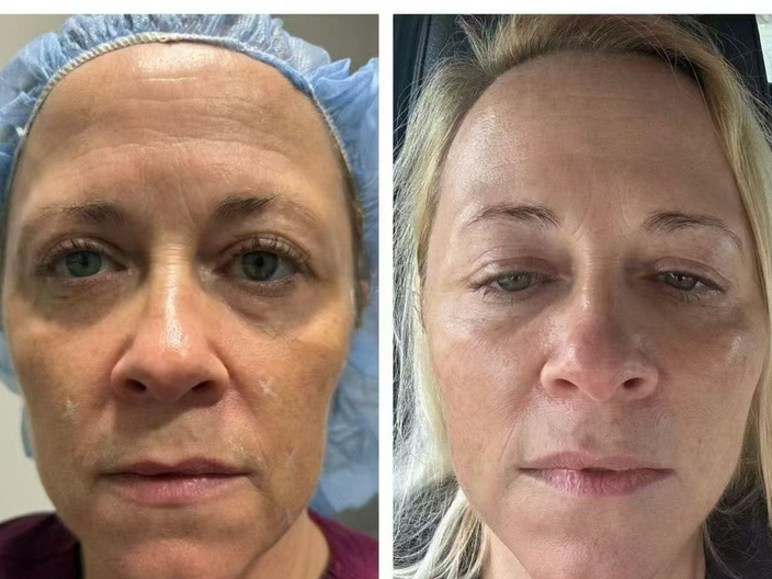 pdo threadlift before after 09