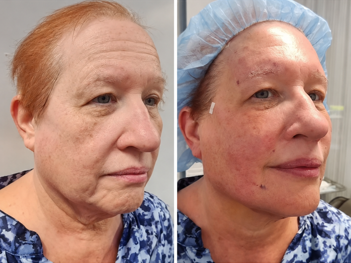 pdo threadlift before after 10