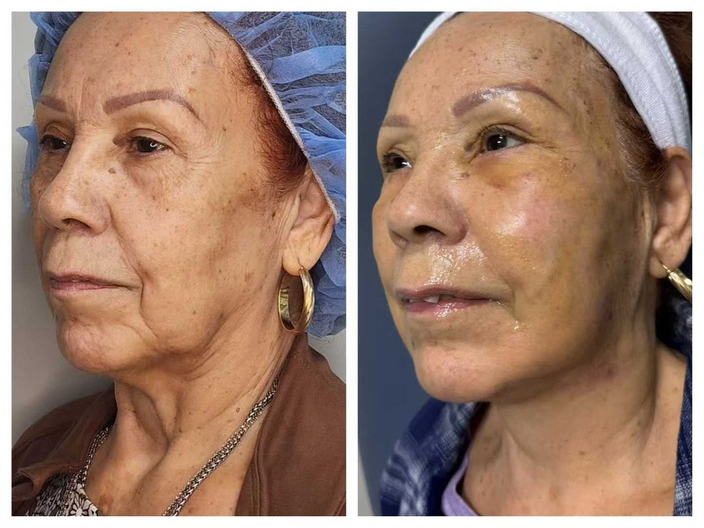 pdo threadlift before after 11