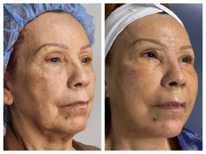 pdo threadlift before after 12