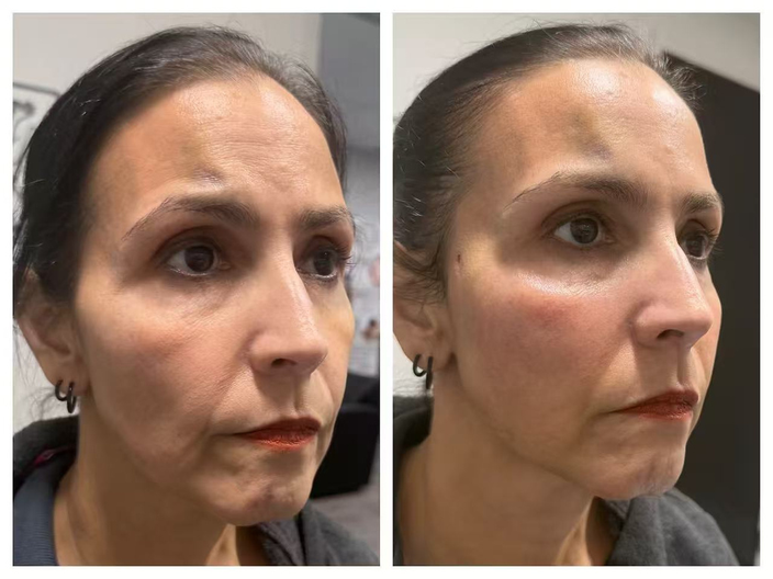 pdo threadlift before after 14